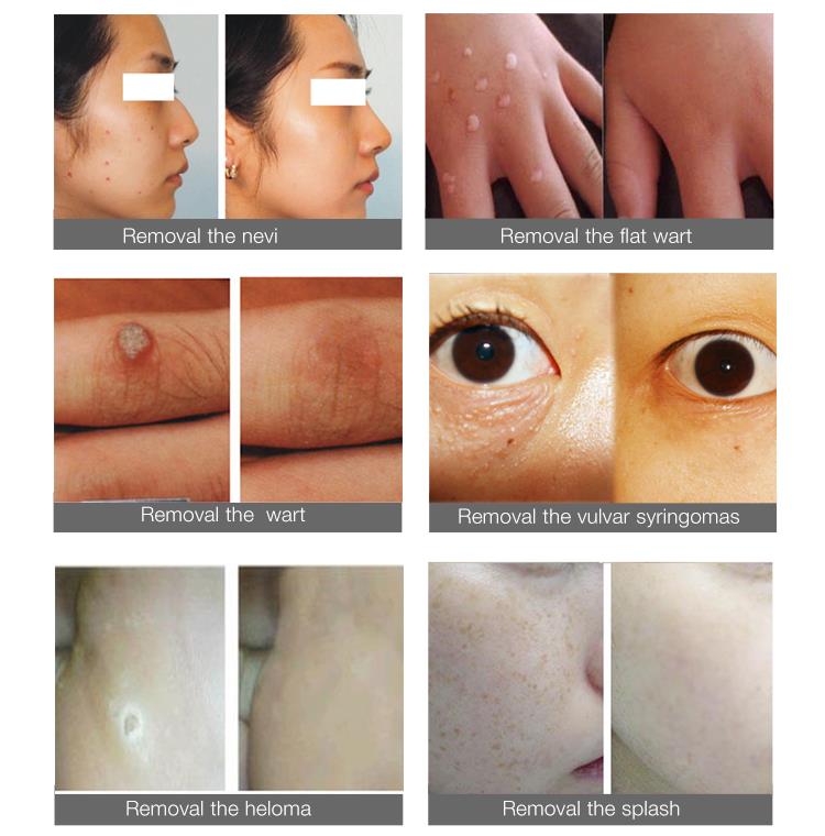 treatment befor and after.jpg