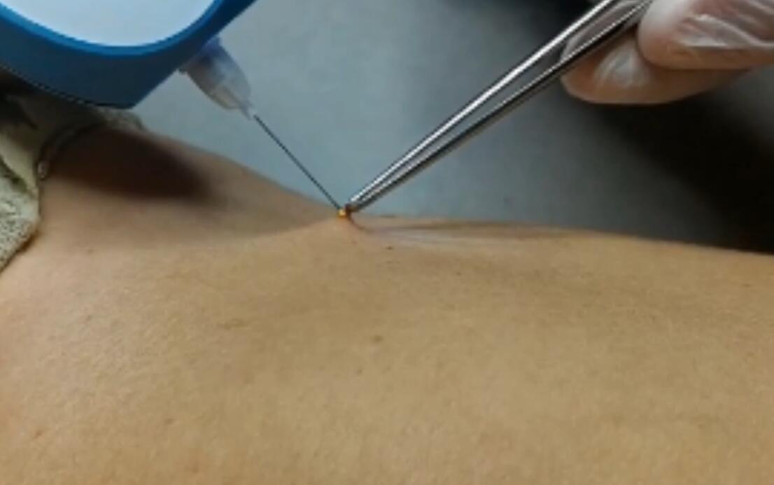mole removal video.jpg
