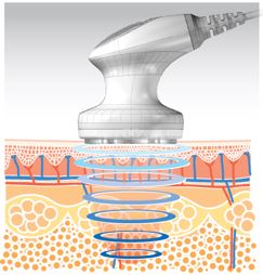 a3tc_Cavitation