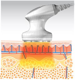 a4tc_Low-Level-laser
